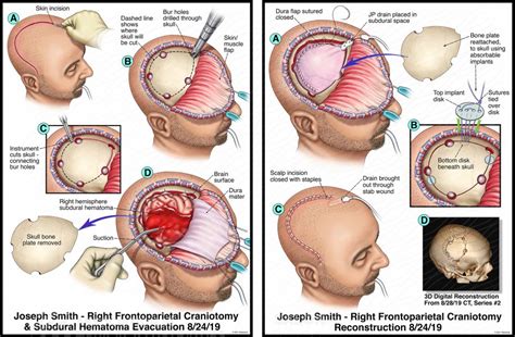 Joseph Smith Right Frontoparietal Craniotomy And Subdural Hematoma