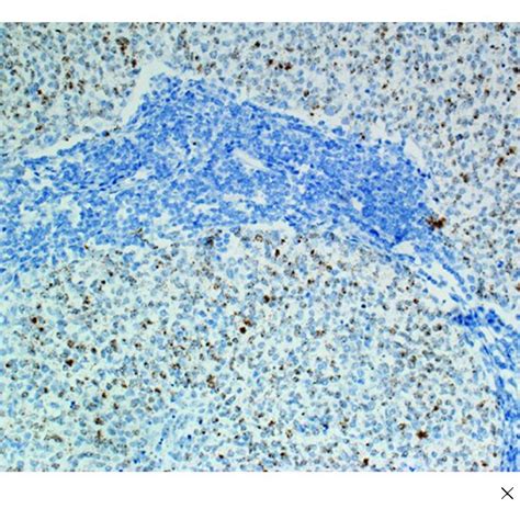 Rnascope Targeting Human Papillomavirus Type 16 E6 And E7 Mrna