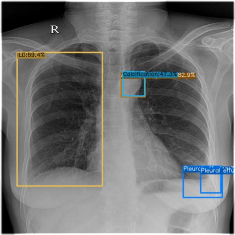 Github Bbonghag Chest X Ray Object Detection Dl Object Detection Project