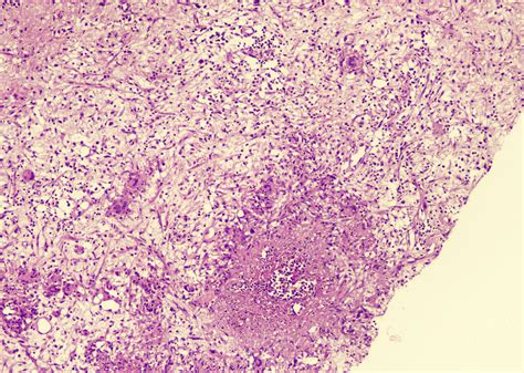 Pathology Outlines Aspergillosis