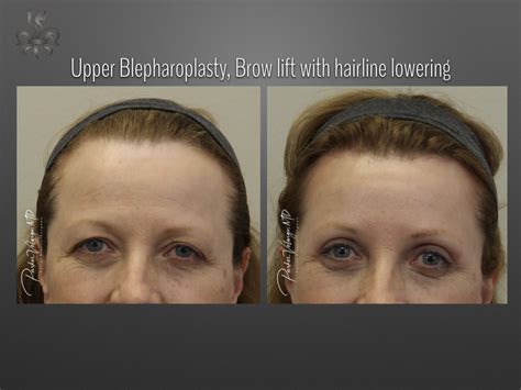 Blepharoplasty New Orleans New Orleans Center For Aesthetic And