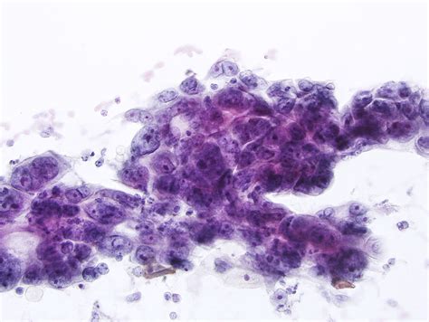 Fig 5 66 Atypical Squamous Cells Of Undetermined Significance ASC US