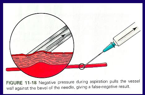 Max Injection Techniques Flashcards Quizlet