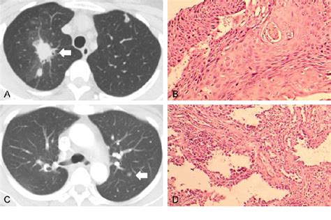 Figure 2 From Single Stage Surgical Treatment Of Synchronous Multiple Primary Lung Cancers A