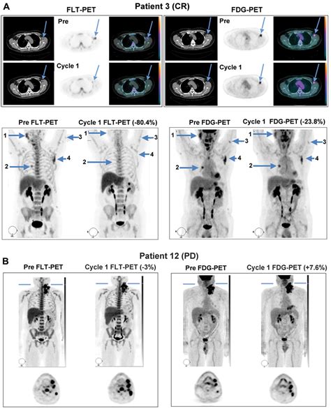 Representative FLT PET CT And FDG PET CT Images At Baseline And During