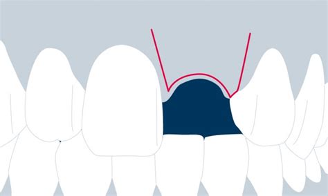 Principles Of Flap Design In Dental Implantology Iti Blog