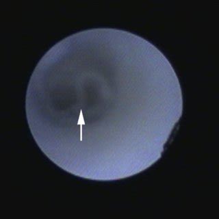 Endoscopic View Of Sclerotic Mucosa Of The Ductal Wall And Mucus Plug