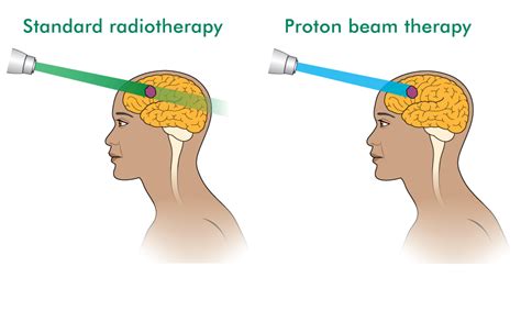 Proton Beam Therapy Locations