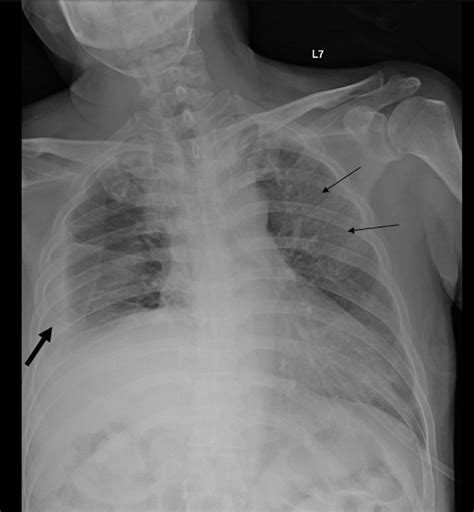 A Follow Up Chest X Ray Revealed Improvement With Regard To