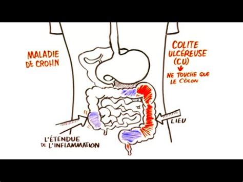 Douleurs abdominales les causes les remèdes traitement les symptômes