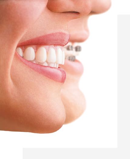 Aparat Invisalign Niewidoczny Aparat Ortodontyczny Bielsko Bia A