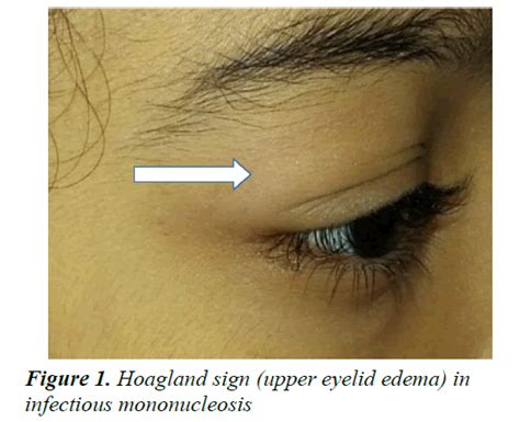 Hoagland Sign An Early Manifestation Of Acute Infectious Mononucleosis