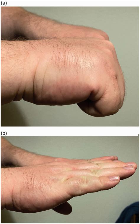 Mild Boxer Fracture