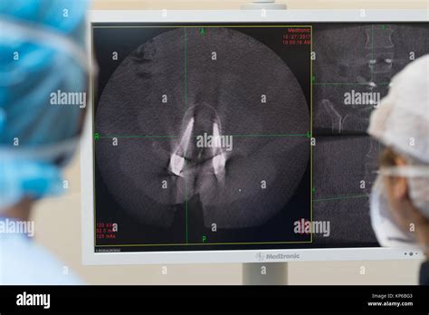 La chirurgie de la colonne vertébrale Photo Stock - Alamy