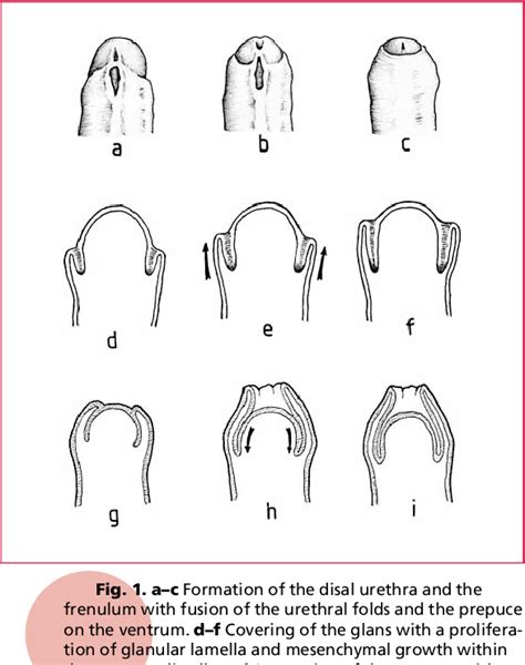 Figure 1 From Curriculum In Urology Phimosis And Circumcision In