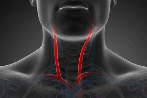 Artère carotide schéma AVC qu est ce que c est