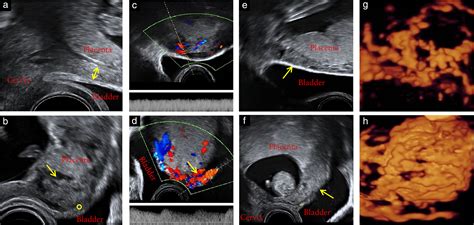 Screening For Morbidly Adherent Placenta In Early Pregnancy