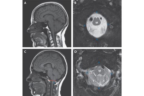 Symptomatic Chiari Malformation Type 1 Nejm Resident 360