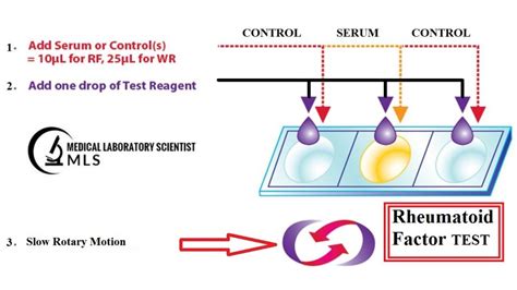 RF Latex Agglutination Test (Rheumatoid Factor): Principle, Procedure, Requirements, Results and ...