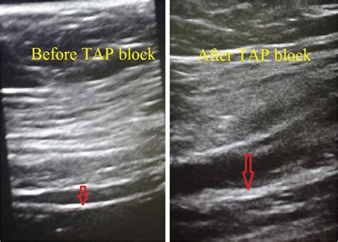 Process Of Tap Block As Seen On Ultrasound Examination Download Scientific Diagram