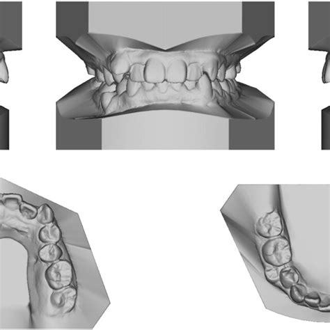 Pretreatment And Posttreatment Radiographs A Pretreatment Panoramic