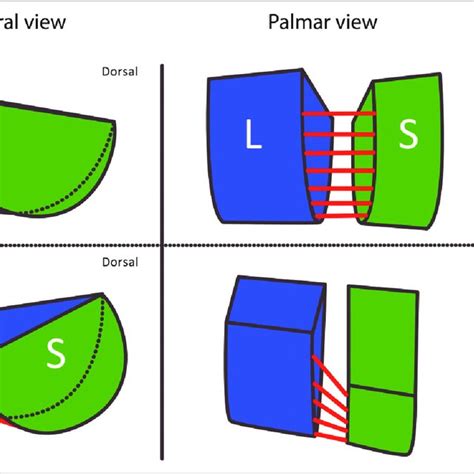 Lateral View Of The Change In Position Of The Scaphoid Relative To The