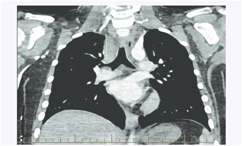 Ct Chest Showing The Presence Of Right Paratracheal And Subcarinal Soft Download Scientific