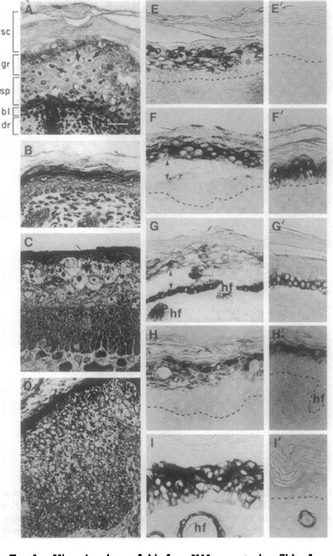 Hyperkeratosis, Epidermolytic | Semantic Scholar