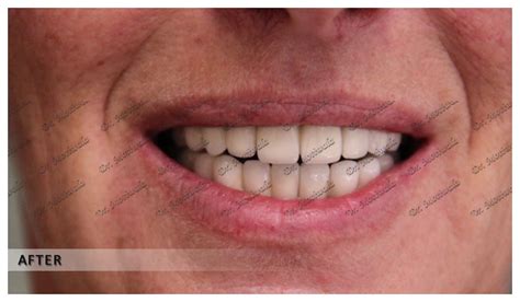 Full Mouth Dental Implants Before And After Dental Clinic