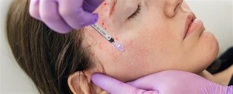 Prp Vampire Facial Treatment Vampire Facial In Delhi The Face Centre