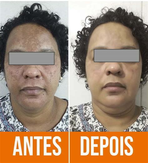 Melasma Antes E Depois Veja O Resultado Do Tratamento Laser CO2