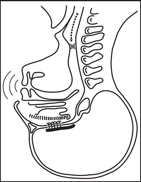 Esophageal Speech Figure 4 Electrolarynx Speech Download Scientific