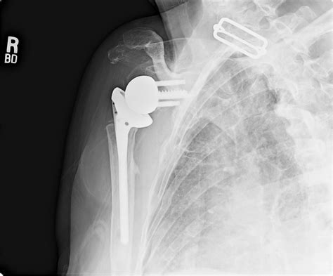 Shoulder and Elbow Surgery: Proximal humerus nonunion in the elderly ...