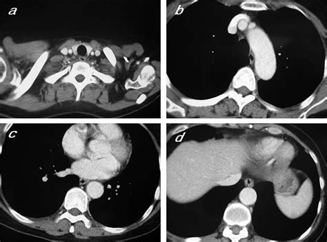 Observation Of Normal Appearance And Wall Thickness Of Esophagus On Ct