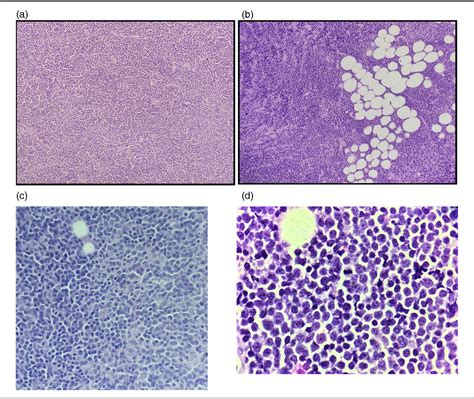 Figure 1 From Aggressive Cyclin D1 Negative Blastoid Variant Mantle Cell Lymphoma—a Case Report