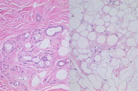 Pathology Of Gangrene Intechopen