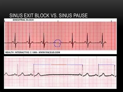 P wave axis and escape rhythms