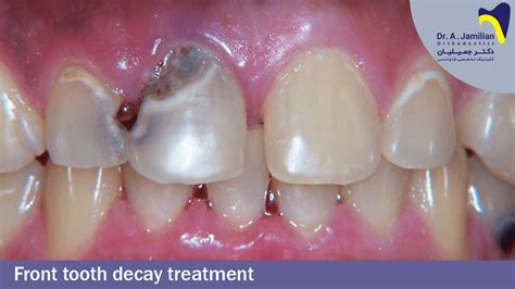 Front tooth decay treatment - Dr Jamilian