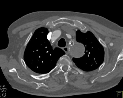 Occlusion Left Subclavian Artery With Bypass From The Left Carotid