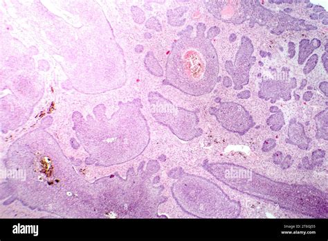 Fotomicrografía Del Carcinoma Basocelular Que Muestra Células Basales