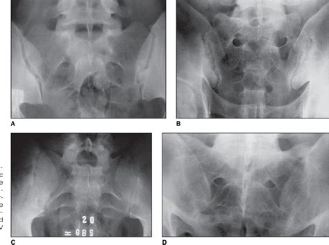 Normal Sacroiliac Joint Xray