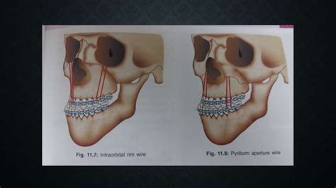 Lefort Fracture Ppt