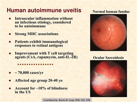 PPT - Experimental autoimmune uveitis as a model of human uveitis ...