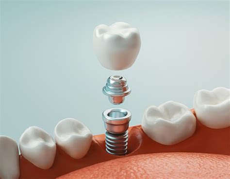 Things You Should Know Before Getting Dental Implants Winning Smiles