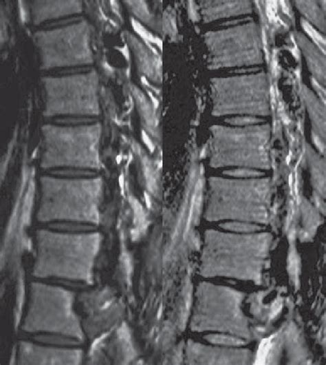 A B Mr Sagittal T1 Weighted A And T2 Weighted B Images Confirming