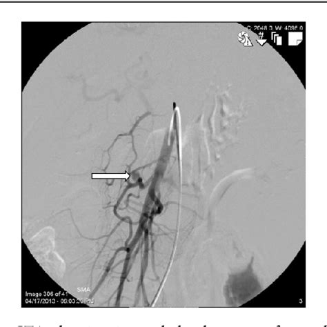 Figure From Hemosuccus Pancreaticus With Superior Mesenteric Artery