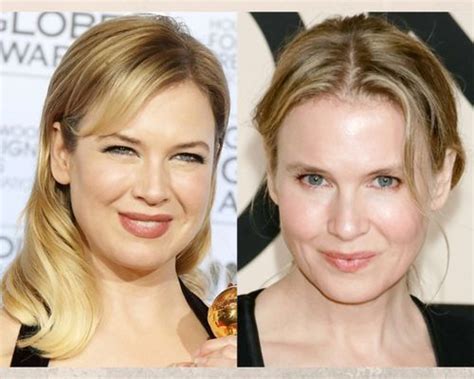 Renee Zellweger Plastic Surgery Secrets Complete Guide Fabbon