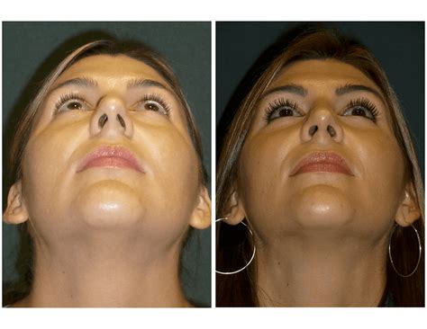 Deviated Septum Surgery Before And After