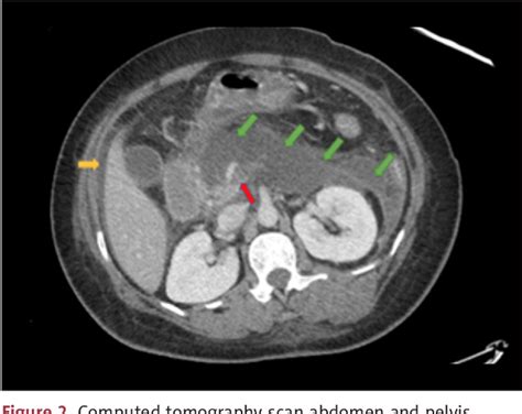 Figure 2 From A Case Of Acute Pancreatitis Associated With Early Stage