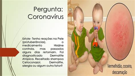 Tenho Dermatite Atópica Fico reações na pele uso Hixizine e